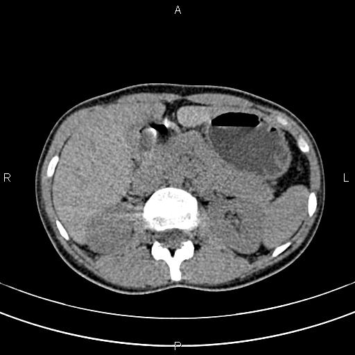 File:Calcified hepatic hydatid cyst (Radiopaedia 83870-99072 Axial non-contrast 60).jpg