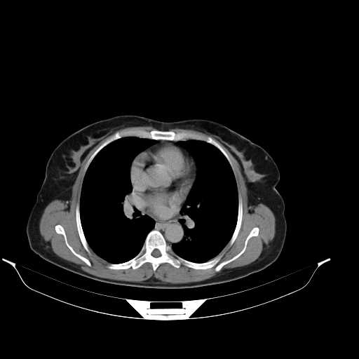 File:Calcified hydatid cyst of the liver (Radiopaedia 21212-21112 Axial C+ delayed 1).jpg