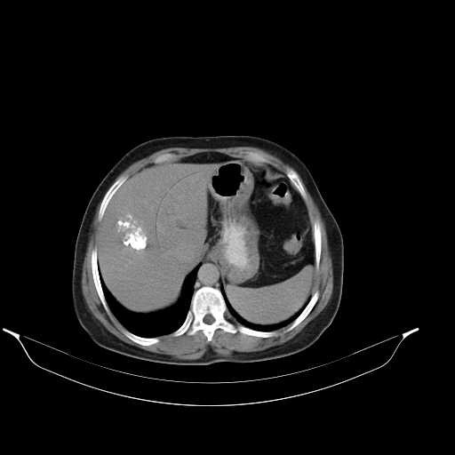 File:Calcified hydatid cyst of the liver (Radiopaedia 21212-21112 Axial C+ delayed 12).jpg