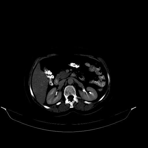 File:Calcified hydatid cyst of the liver (Radiopaedia 21212-21112 Axial bone window 21).jpg