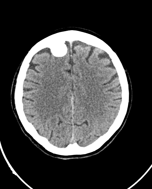Calcified meningioma (Radiopaedia 74361-85243 Axial non-contrast 17).jpg