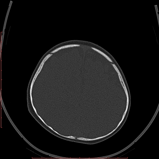 Calcified middle cerebral artery embolism (Radiopaedia 78949-91860 Axial bone window 57).jpg