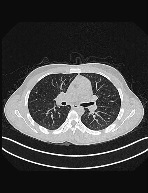Calcifying pulmonary metastases (Radiopaedia 33359-34396 Axial lung window 28).jpg