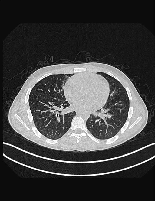 Calcifying pulmonary metastases (Radiopaedia 33359-34396 Axial lung window 38).jpg