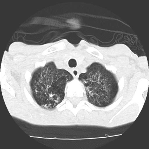 File:Calciphylaxis and metastatic pulmonary calcification (Radiopaedia 10887-11317 Axial lung window 1).jpg