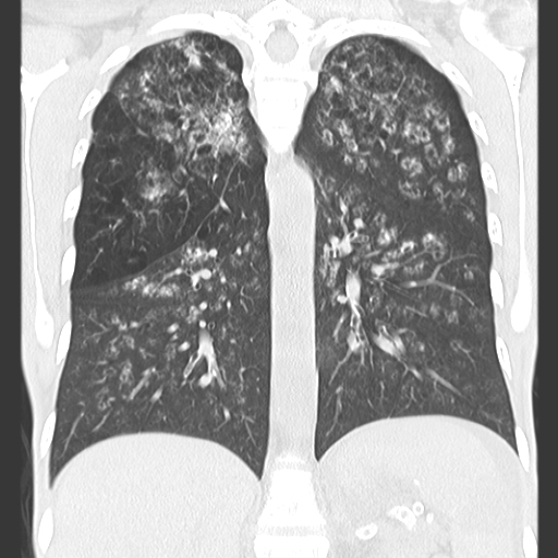 File:Calciphylaxis and metastatic pulmonary calcification (Radiopaedia 10887-11317 C 10).jpg