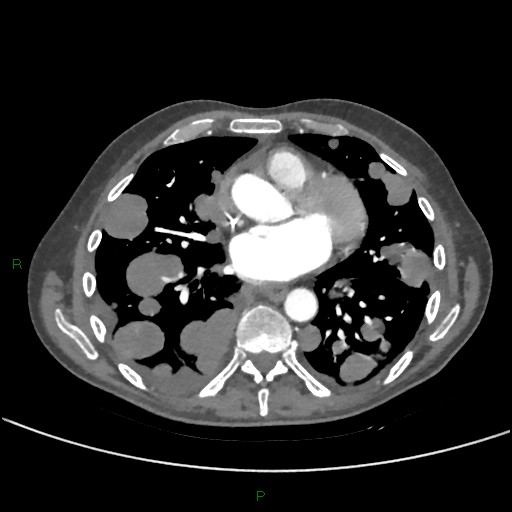 Cannonball metastases (Radiopaedia 82110-96150 Axial C+ CTPA 194).jpg
