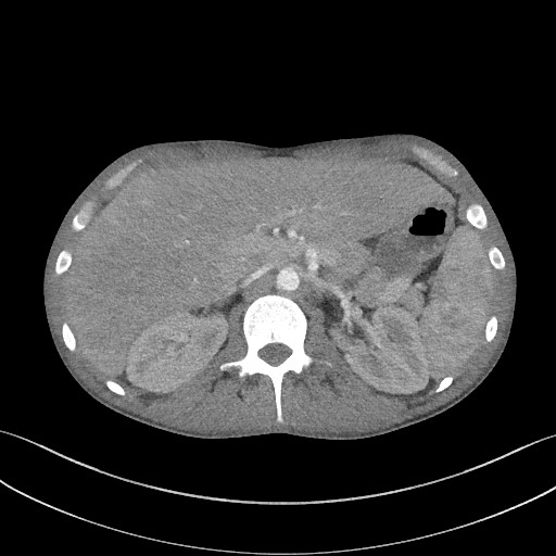 Cannonball metastases - testicular choriocarcinoma (Radiopaedia 84510-99891 B 112).jpg