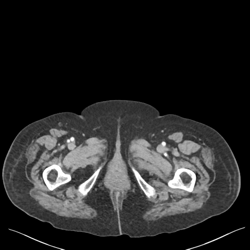 Cannonball metastases from endometrial cancer (Radiopaedia 42003-45031 E 83).png