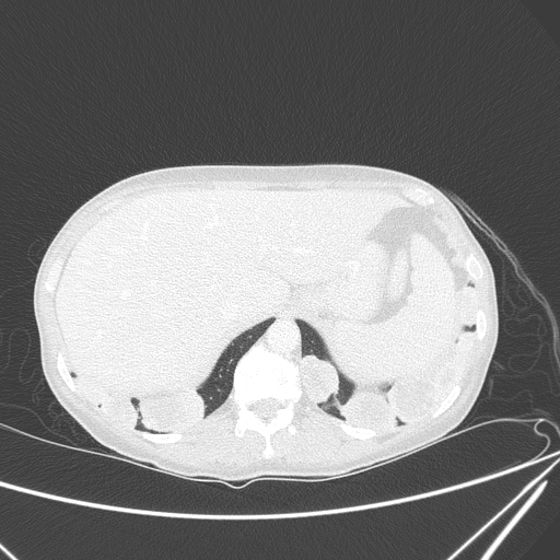 Canonball lung metastasis (Radiopaedia 77634-89837 Axial lung window 165).jpg