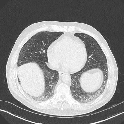 Caplan syndrome (Radiopaedia 56667-63530 Axial lung window 139).jpg