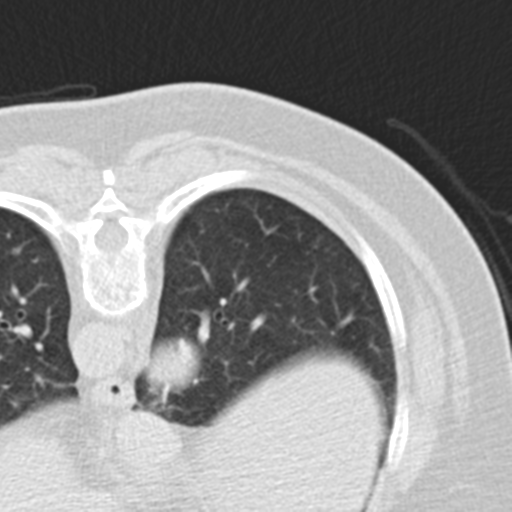 File:Carcinoid tumor - lung (Radiopaedia 44814-48644 Axial lung window 44).png