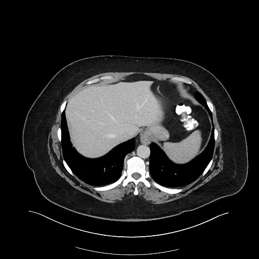 File:Carcinoid tumor - terminal ileum (Radiopaedia 60931-68739 A 20).jpg
