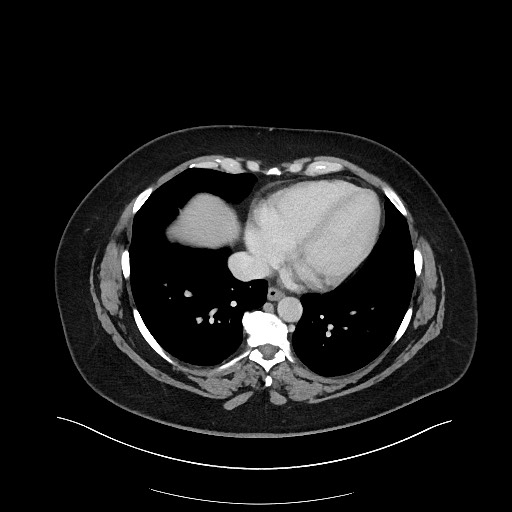 File:Carcinoid tumor - terminal ileum (Radiopaedia 60931-68739 Axial 125).jpg