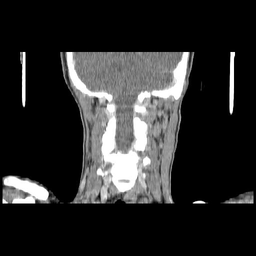Carcinoma of the maxillary antrum (Radiopaedia 53805-59888 Coronal C+ delayed 122).jpg