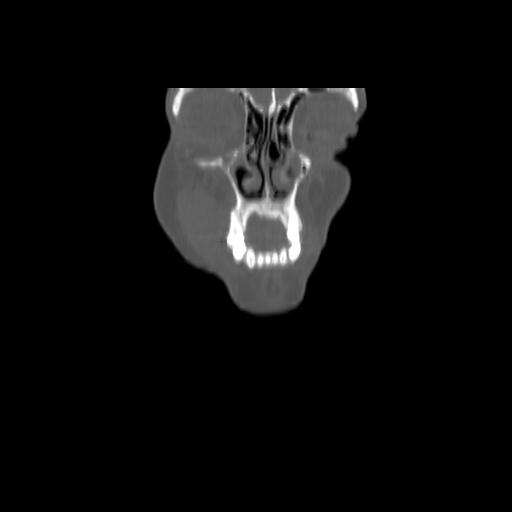 Carcinoma of the maxillary antrum (Radiopaedia 53805-59888 Coronal bone window 21).jpg