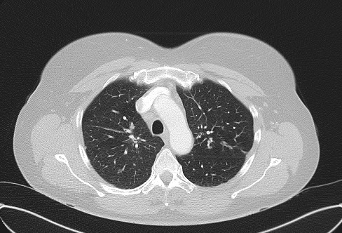 File:Cardiac sarcoidosis (Radiopaedia 74548-85534 Axial lung window 23).jpg