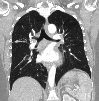 Cardiac sarcoidosis (Radiopaedia 74548-85534 Coronal lung window 39).jpg