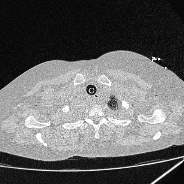 Cardiogenic pulmonary edema (Radiopaedia 29213-29609 Axial lung window 4).jpg