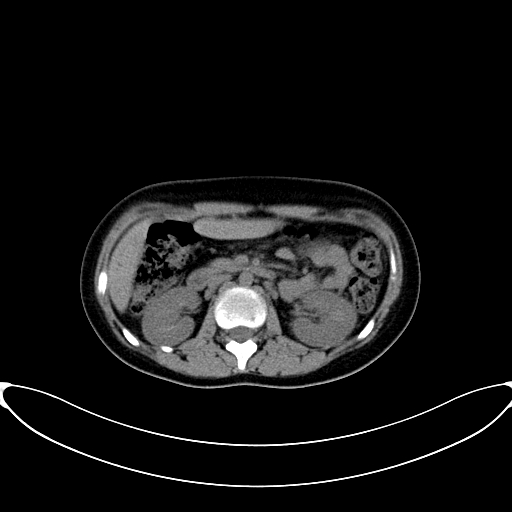 Caroli disease with medullary sponge kidney (Radiopaedia 82622-96804 Axial non-contrast 29).jpg