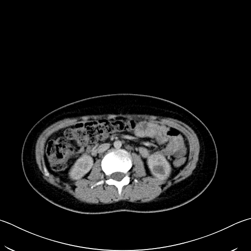 Caroli disease with medullary sponge kidney (Radiopaedia 82622-96804 C 35).jpg