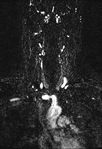Carotid artery dissection (Radiopaedia 28441-28689 Coronal MRA 29).jpg