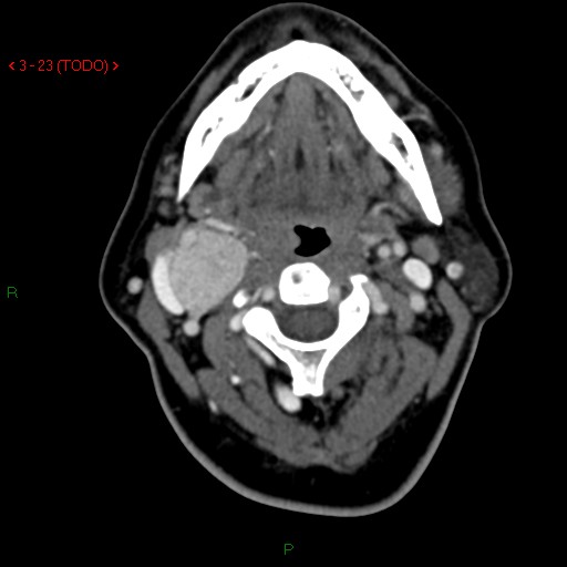 File:Carotid body tumor (Radiopaedia 20564-20462 B 1).jpg