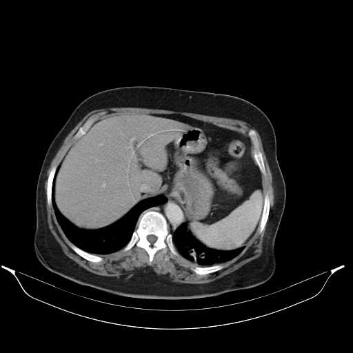 File:Carotid body tumor (Radiopaedia 21021-20948 A 52).jpg