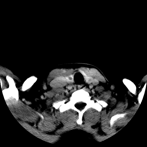 File:Carotid body tumor (Radiopaedia 27890-28124 A 24).jpg