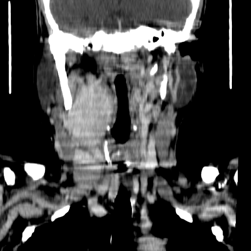 File:Carotid body tumor (Radiopaedia 27890-28124 B 9).jpg