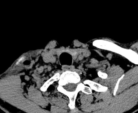 Carotid body tumor (Radiopaedia 61750-69757 Axial non-contrast 104).jpg