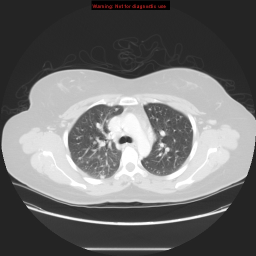 Carotid body tumor with lung metastases (Radiopaedia 9301-48390 Axial lung window 27).jpg