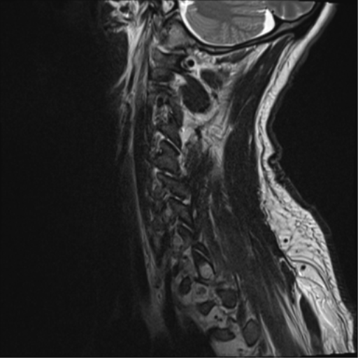 File:Cavernoma of cervical cord (Radiopaedia 50838-56347 C 1).png