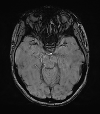 File:Cavernoma with bleed - midbrain (Radiopaedia 54546-60773 Axial SWI 19).png
