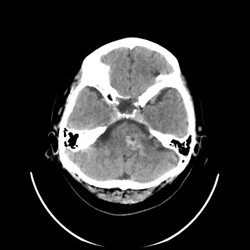 File:Cavernoma with developmental venous anomaly (Radiopaedia 22470-22506 non-contrast 9).jpg
