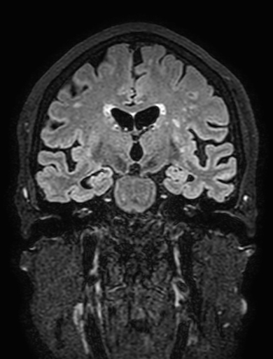 Cavernous hemangioma of the cerebellar falx (Radiopaedia 73025-83724 Coronal FLAIR 172).jpg