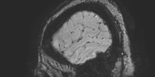 Cavernous hemangioma of the cerebellar falx (Radiopaedia 73025-83724 Sagittal BOLD 17).jpg
