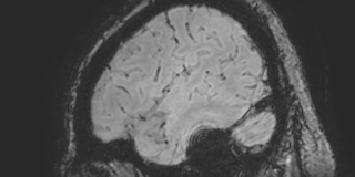 Cavernous hemangioma of the cerebellar falx (Radiopaedia 73025-83724 Sagittal BOLD 175).jpg