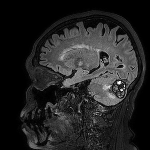 Cavernous hemangioma of the cerebellar falx (Radiopaedia 73025-83724 Sagittal FLAIR 143).jpg
