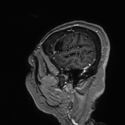 Cavernous hemangioma of the cerebellar falx (Radiopaedia 73025-83724 Sagittal T1 C+ 25).jpg