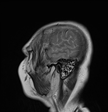 File:Cavernous sinus meningioma (Radiopaedia 63682-72367 Sagittal T2 2).jpg