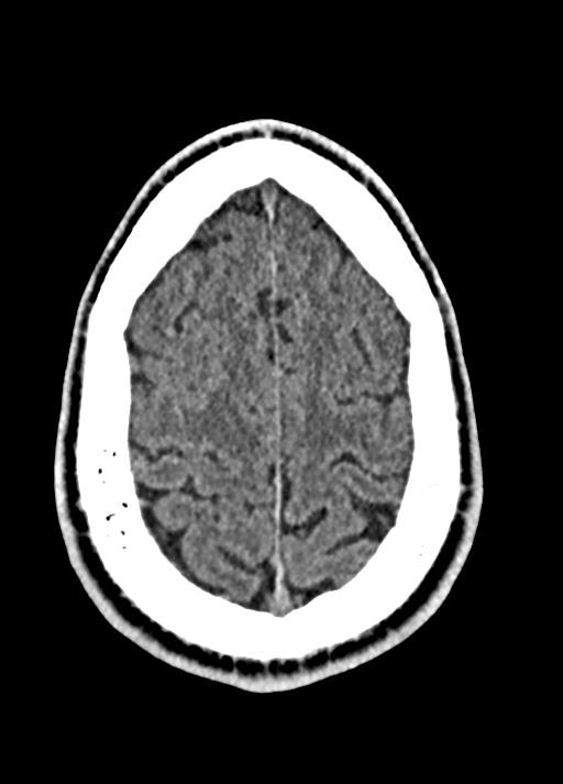 Cavum septum pellucidum and cavum vergae (Radiopaedia 77797-90060 Axial Brain Window 87).jpg