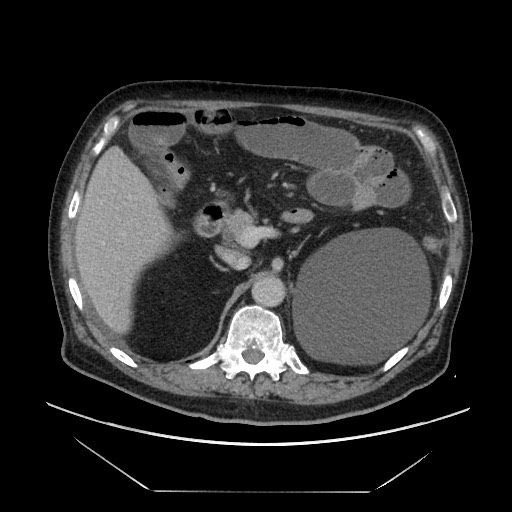 Cecal adenocarcinoma (Radiopaedia 64871-73817 A 26).jpg