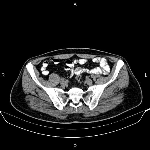 File:Cecal adenocarcinoma (Radiopaedia 85324-100916 Axial non-contrast 75).jpg