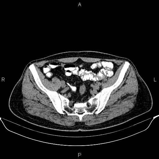 Cecal adenocarcinoma (Radiopaedia 85324-100916 Axial non-contrast 78).jpg
