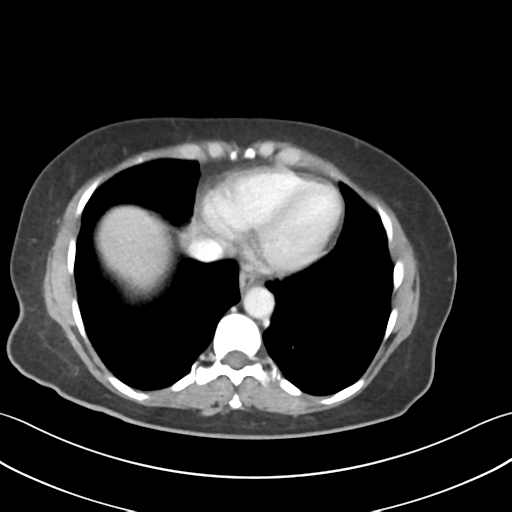 File:Cecum hernia through the foramen of Winslow (Radiopaedia 46634-51112 A 7).png