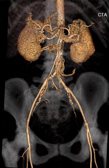 File:Celiac artery severe stenosis and dissection (Radiopaedia 44128-47842 C+ arterial phase 1).jpg