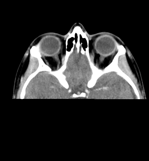 File:Cemento-ossifying fibroma (Radiopaedia 46243-50643 Axial C+ delayed 14).png