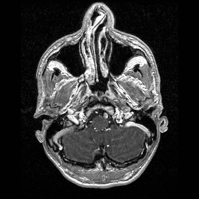 Central-variant posterior reversible encephalopathy syndrome (PRES) (Radiopaedia 43880-47358 Axial T1 C+ 13).jpg