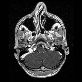 Central-variant posterior reversible encephalopathy syndrome (PRES) (Radiopaedia 43880-47358 Axial T1 C+ 18).jpg